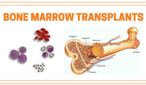 The Various Steps Of Bone Marrow Transplantation