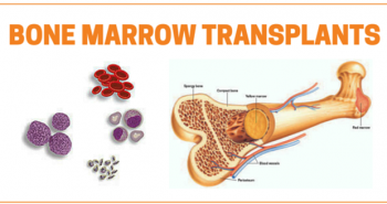 The Various Steps Of Bone Marrow Transplantation