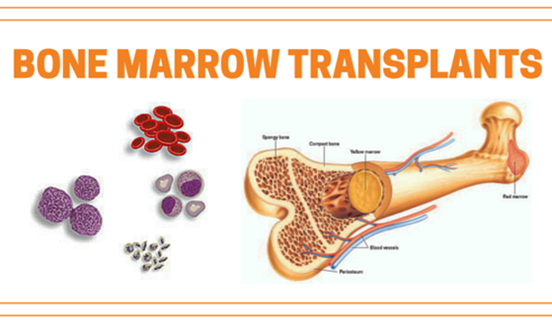 The Various Steps Of Bone Marrow Transplantation